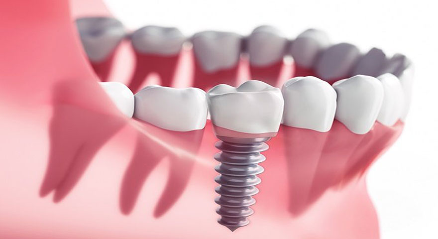 قیمت دندان مصنوعی ثابت بر پایه ایمپلنت