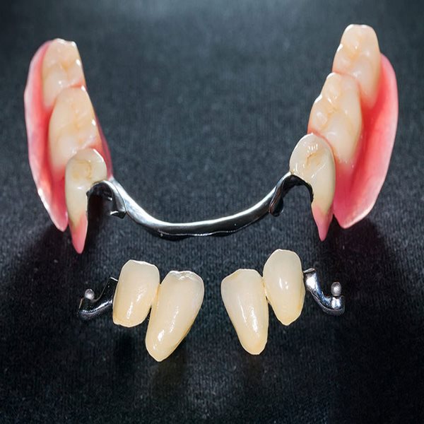 مزایای استفاده از دندان مصنوعی اپل