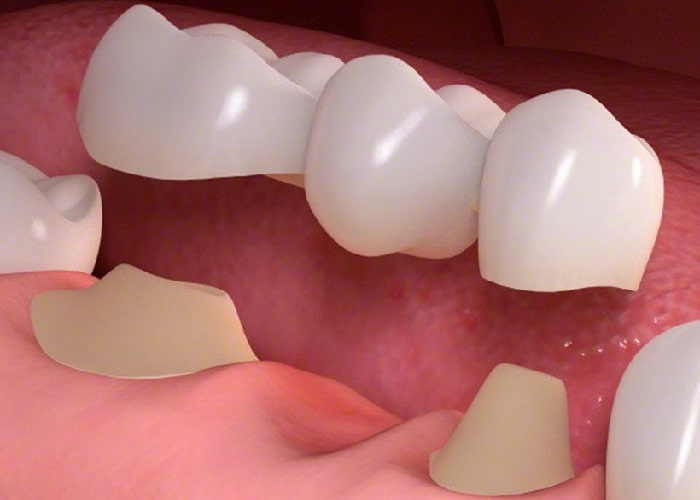 مزایا و کاربردهای عمده بریج دندان