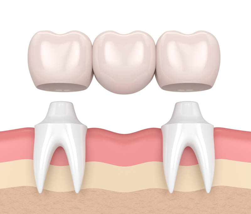 عوارض بریج دندان