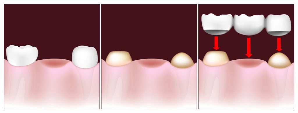 پل دندان
