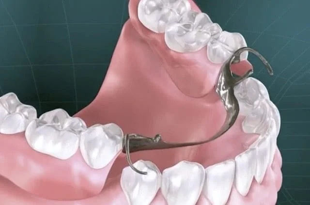 درصد تامین اجتماعی برای پارشیال چند دندانی