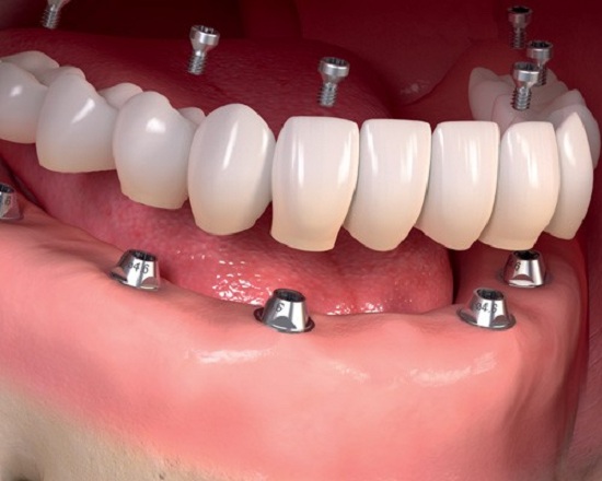 کاشت دندان به روش ایمپلنت