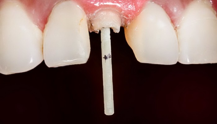 مراحل درمان پست و کور به کمک دندانپزشک