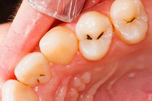 آشنایی با ۸ دلیل پوسیدگی دندان 