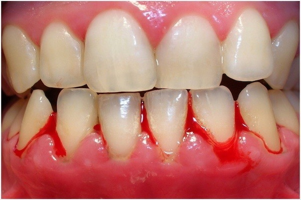 علت خونریزی لثه به واسطه نخ دندان
