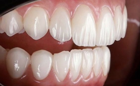 دندان مصنوعی خارجی چیست؟